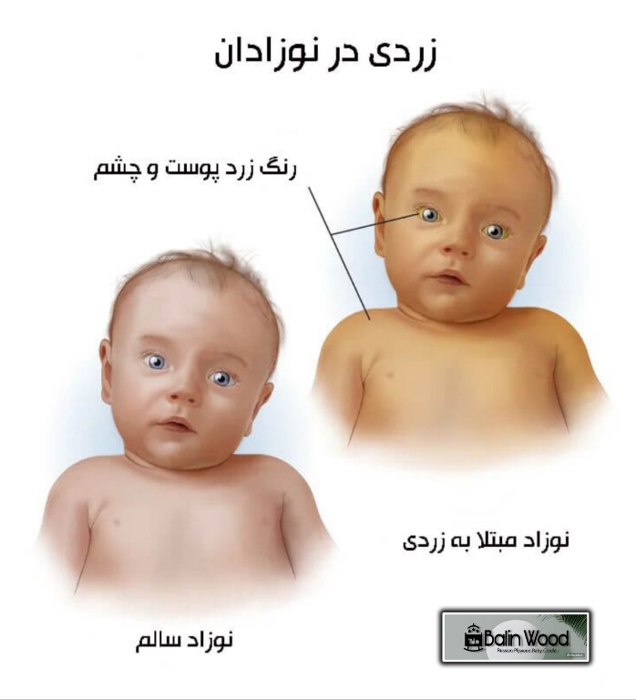 علائم زردی در نوزاد